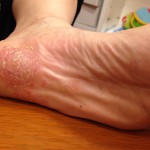 繰り返す手足の湿疹