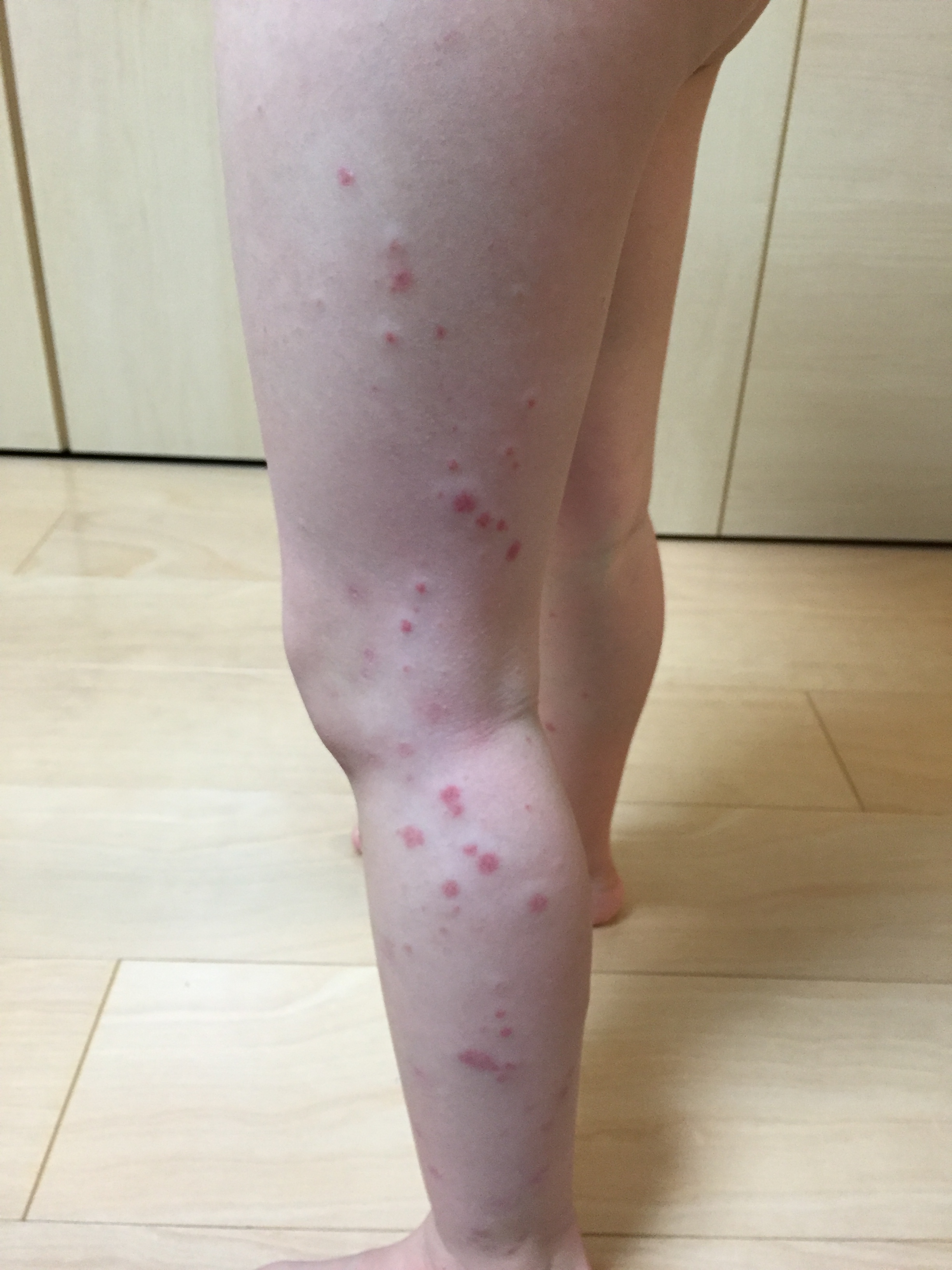 アレルギー性紫斑病も漢方薬で解決 漢方 静岡 ふじみ薬局